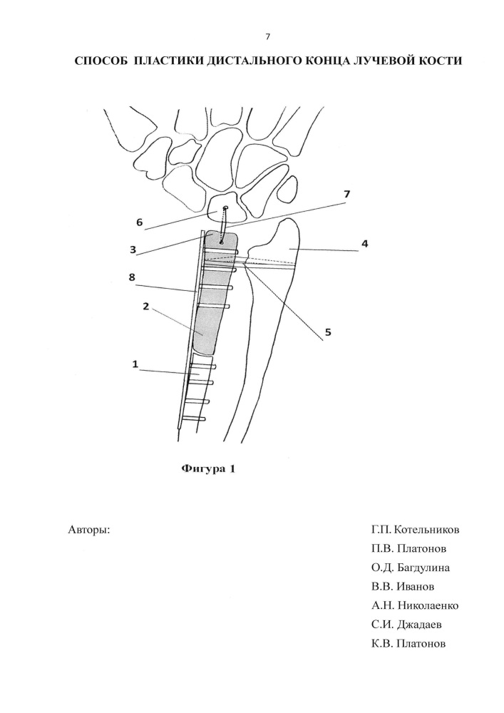 Способ пластики дистального конца лучевой кости (патент 2607567)