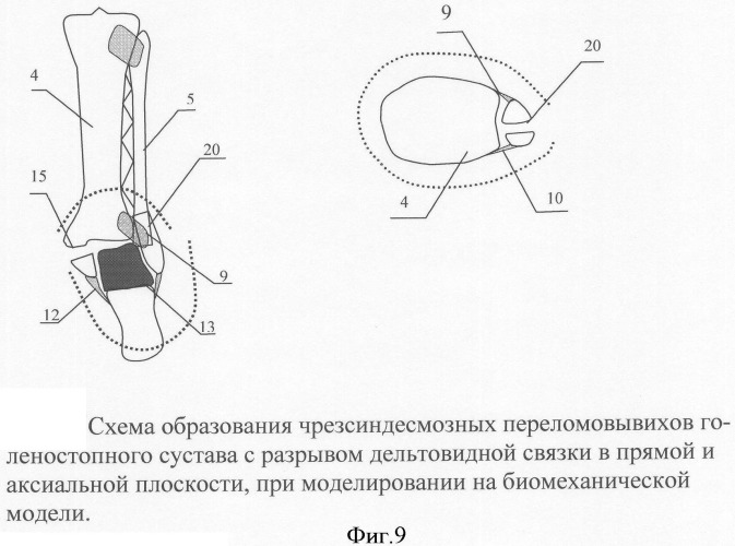 Модель системы стабилизации таранной кости при переломовывихах голеностопного сустава (патент 2340010)