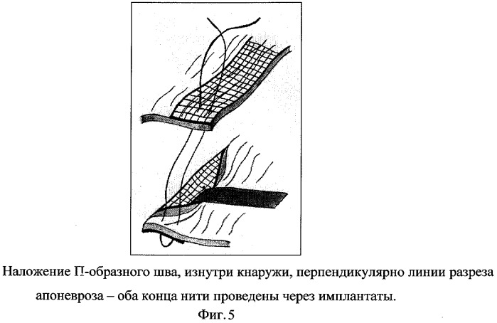 Способ ушивания апоневроза (патент 2277384)