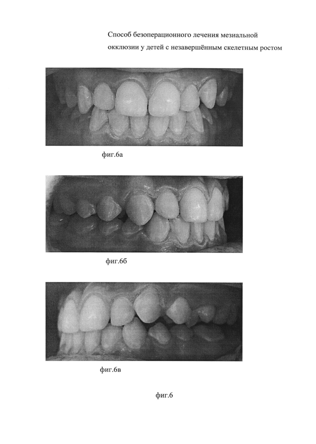 Способ безоперационного лечения мезиальной окклюзии у детей с незавершённым скелетным ростом (патент 2593234)