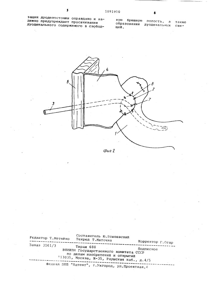 Способ дуоденостомии по ю.т.коморовскому (патент 1091910)