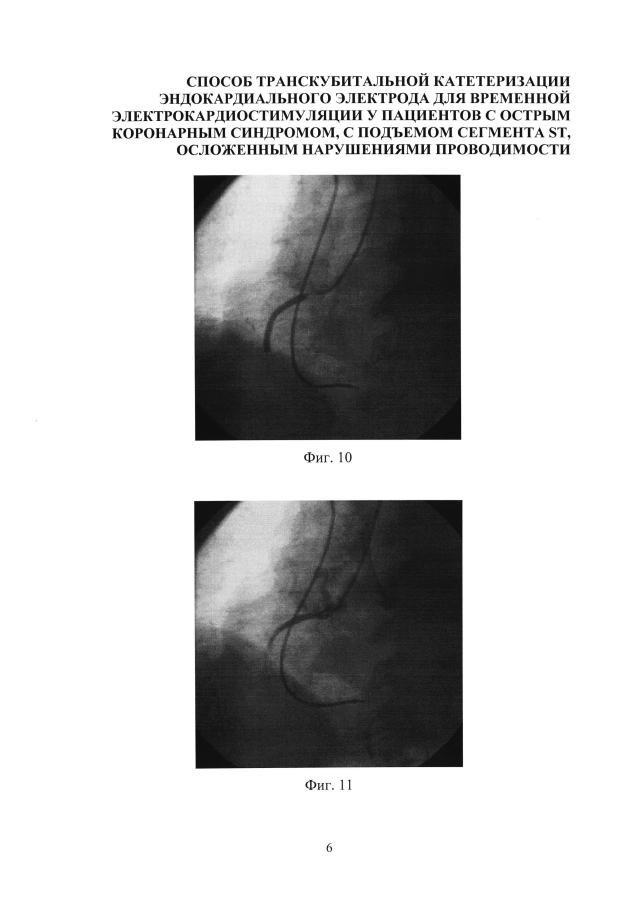 Способ катетеризации сердца для установки эндокардиального электрода для временной электрокардиостимуляции у пациентов с острым коронарным синдромом, с подъемом сегмента st, осложенным нарушениями проводимости (варианты) (патент 2594243)