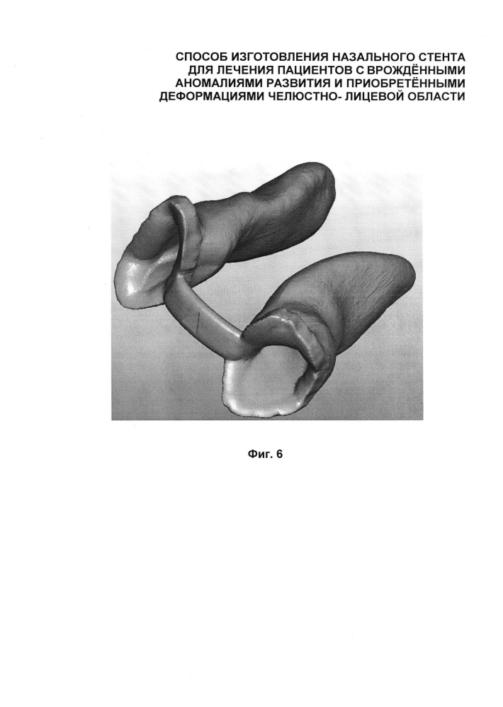 Способ изготовления назального стента для лечения пациентов с врождёнными аномалиями развития и приобретёнными деформациями челюстно-лицевой области (патент 2618187)