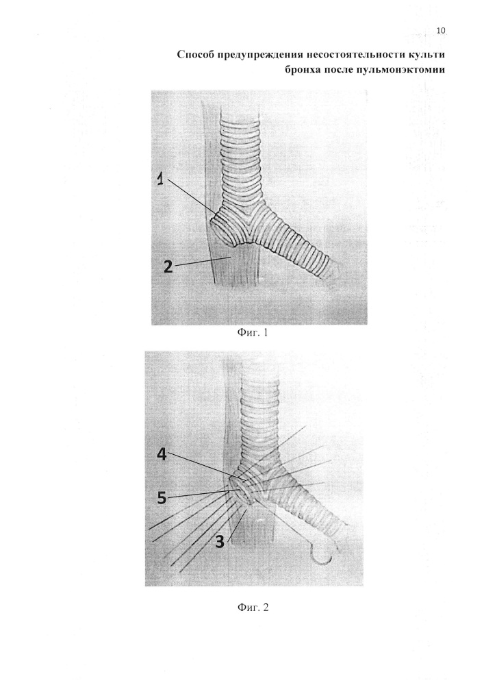 Способ предупреждения несостоятельности культи бронха после пульмонэктомии (патент 2617882)
