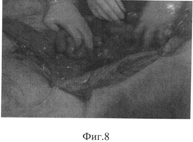 Способ хирургического лечения кишечных непроходимостей тонкого и толстого кишечника и устройство для его осуществления (патент 2502482)