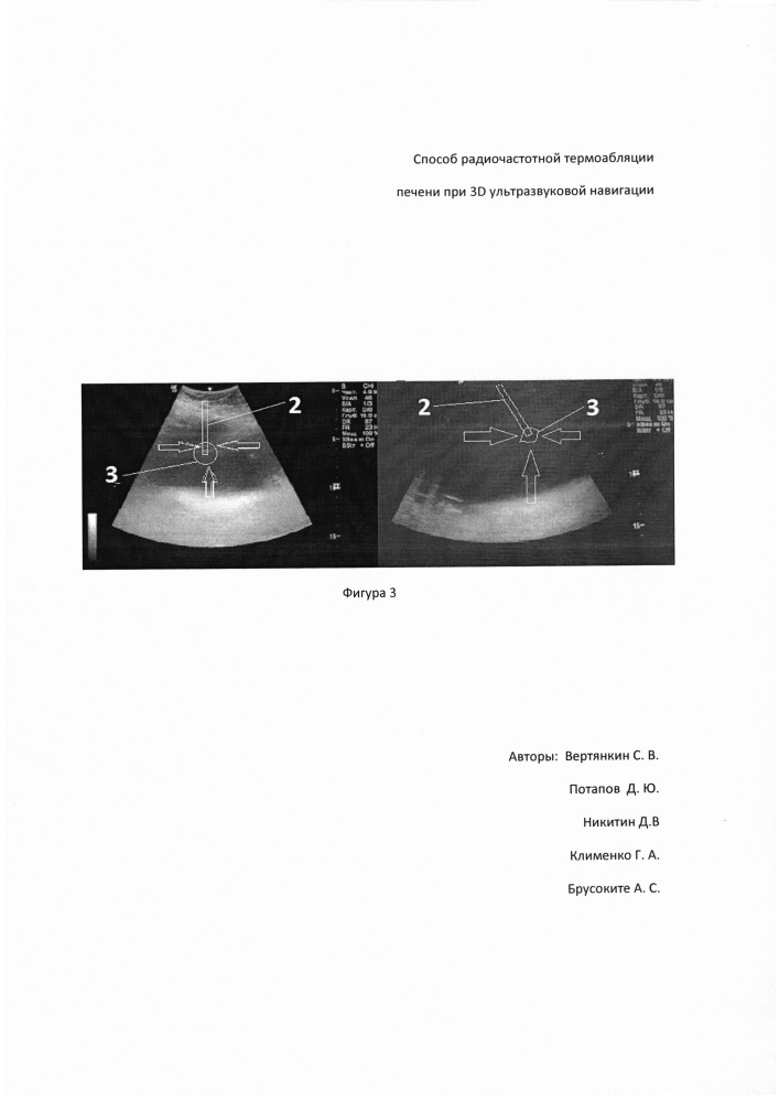 Способ радиочастотной термоабляции опухолевого новообразования печени (патент 2654267)