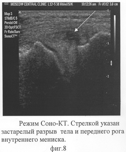 Способ комплексной ультразвуковой диагностики повреждения внутреннего мениска коленного сустава в области тела и переднего рога (патент 2305493)