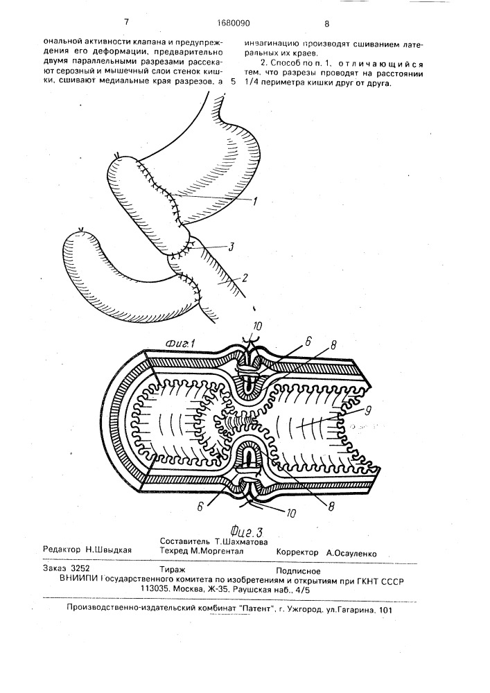 Способ формирования клапана тонкой кишки (патент 1680090)