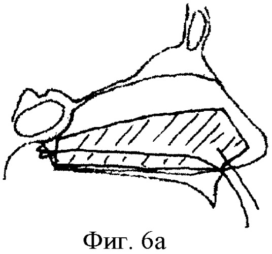 Внутриносовая шина (варианты) и способ ее фиксации (патент 2414180)