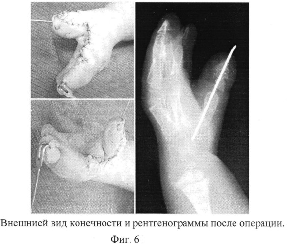 Способ оперативного лечения клинодактилии первого пальца кисти при акроцефалосиндактилии (патент 2546503)