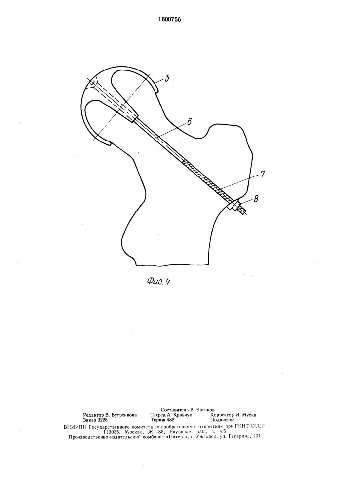 Эндопротез для замещения хрящевой поверхности головки бедра (патент 1600756)