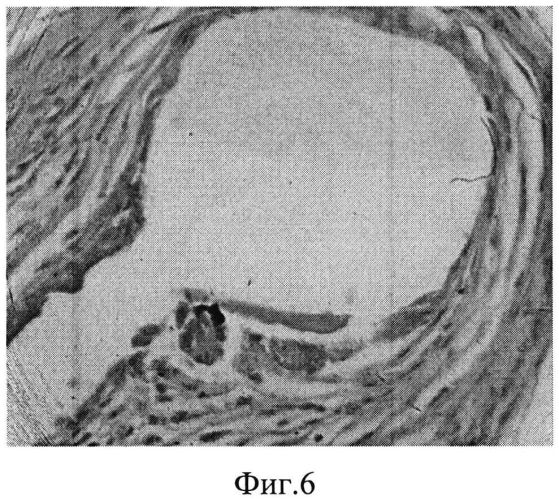 Способ укрепления шва на матке при операции кесарево сечение с применением синтетического эндопротеза (патент 2559281)