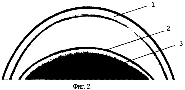 Способ устранения ретенции внутриглазной жидкости при экстракции катаракты у больных с открытоугольной глаукомой (патент 2296543)