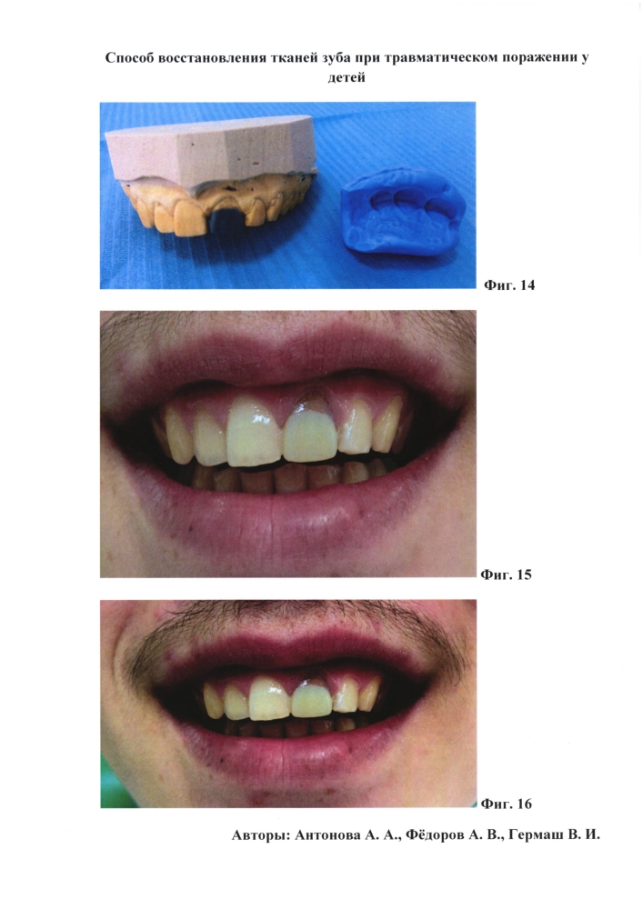 Способ восстановления тканей зуба при травматическом поражении у детей (патент 2604387)