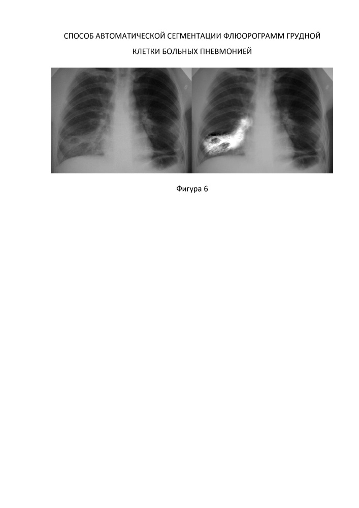 Способ автоматической сегментации флюорограмм грудной клетки больных пневмонией (патент 2629629)