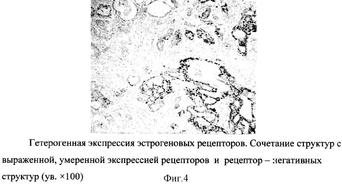 Способ прогнозирования течения заболевания раком молочной железы (патент 2300111)