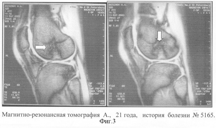 Способ определения глубины и распространенности остеонекроза у пациентов с начальными стадиями рассекающего остеохондрита коленного сустава для проведения артроскопических операций (патент 2284149)