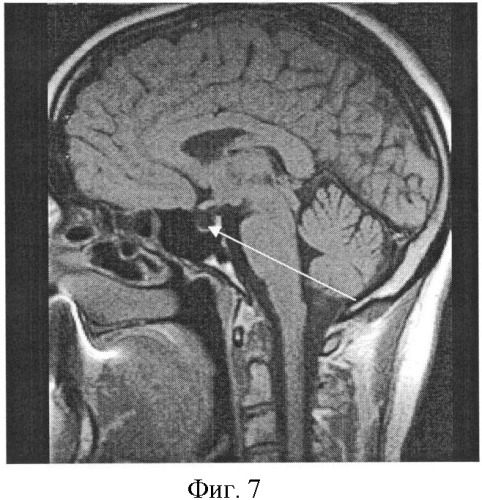 Способ прижизненной диагностики интраселлярной гипертензии на низкопольном магнитно-резонансном томографе (патент 2361512)