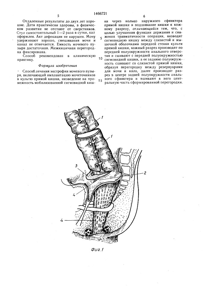 Способ лечения экстрофии мочевого пузыря (патент 1466721)