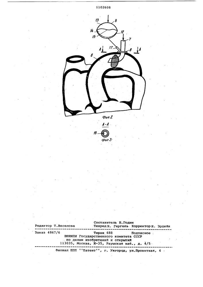 Устройство для полного и вспомогательного искусственного кровообращения (патент 1102608)