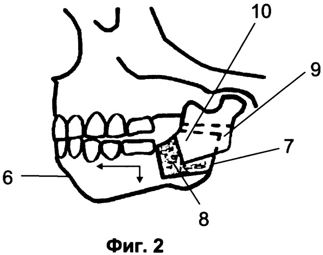 Способ аллопластики при микрогнатии нижней челюсти (патент 2310412)
