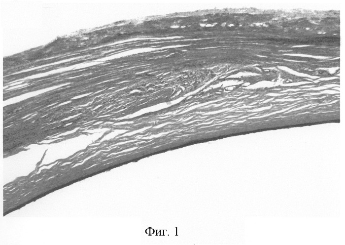 Способ укрепления склеры (патент 2265441)