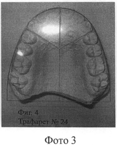 Способ контроля ортодонтической коррекции верхней зубной дуги и ее сегментов (патент 2486875)
