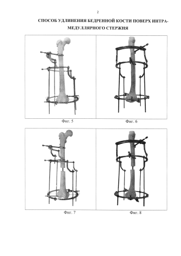 Способ удлинения бедренной кости поверх интрамедуллярного стержня (патент 2584555)