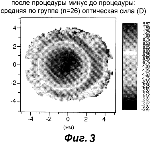 Конструкция офтальмологических линз для контроля близорукости (патент 2575048)