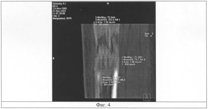 Способ исследования плотности дистракционного регенерата при компьютерной томографии (патент 2289314)