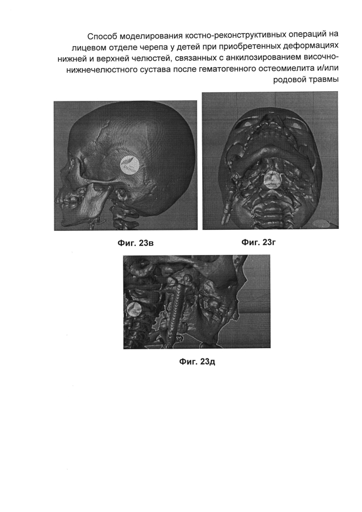 Способ моделирования костно-реконструктивных операций на лицевом отделе черепа у детей при приобретенных деформациях нижней и верхней челюстей, связанных с анкилозированием височно-нижнечелюстного сустава после гематогенного остеомиелита и/или родовой травмы (патент 2604774)