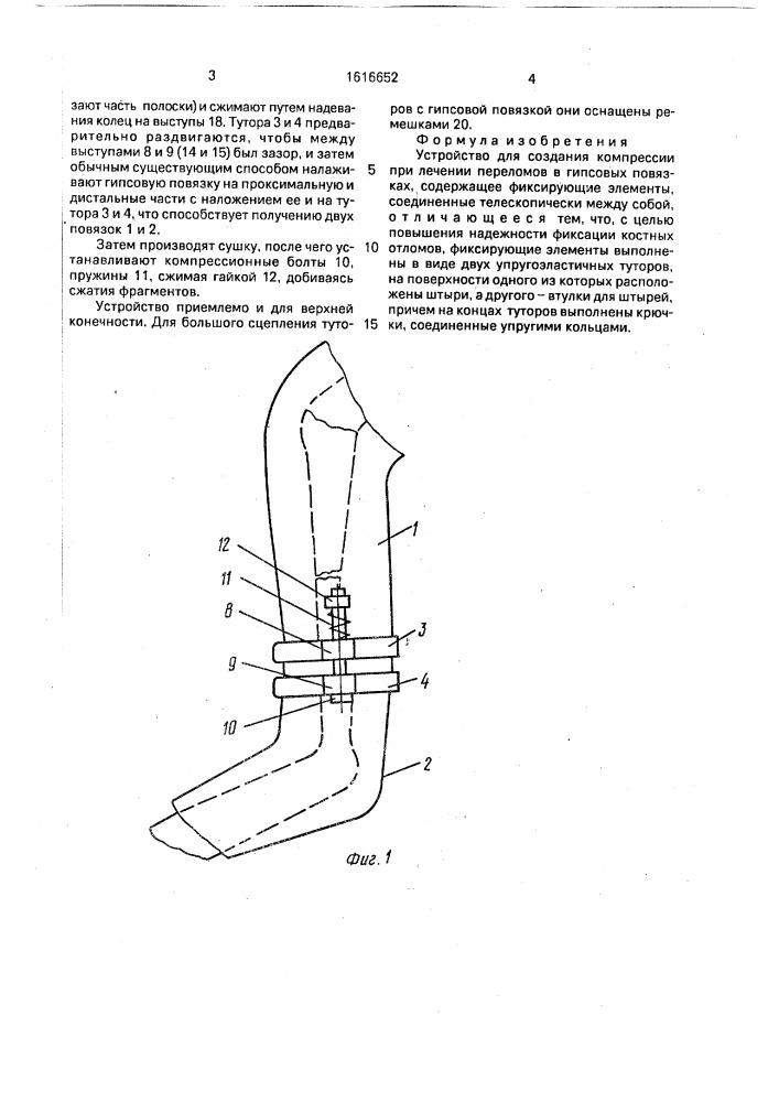 Устройство жеребного для создания компрессии при лечении переломов в гипсовых повязках (патент 1616652)