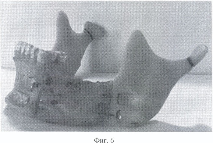 Имплантат для замещения дефектов нижней челюсти (патент 2469682)