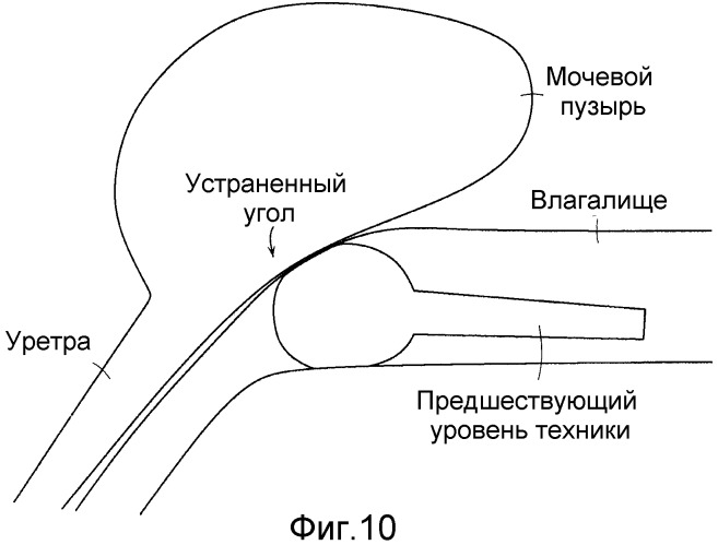 Коррекция стрессового недержания мочи (патент 2548825)