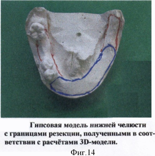 Способ функциональной реабилитации больных, перенесших операции по поводу местнораспространенных опухолей дна полости рта и нижней челюсти (патент 2371141)