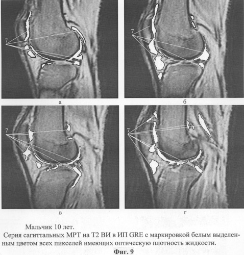 Способ диагностики синовита тазобедренного и коленного суставов с определением количества жидкости в них (патент 2305489)