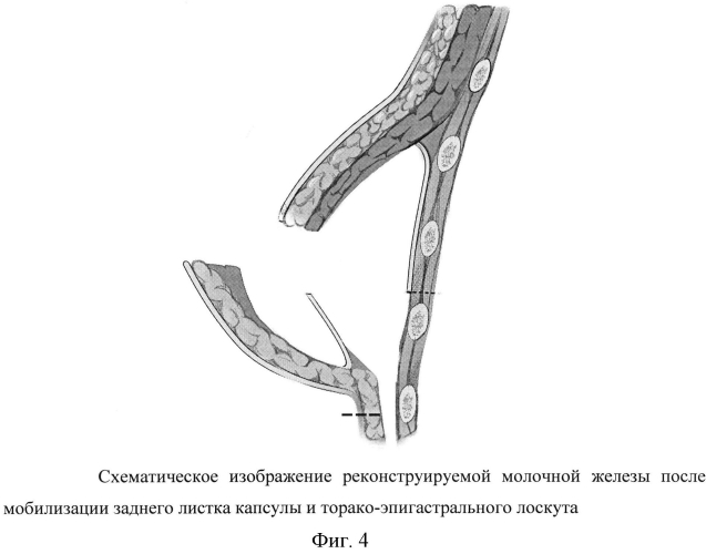 Способ формирования инфрамаммарной складки при двухэтапной реконструкции молочной железы (патент 2567790)