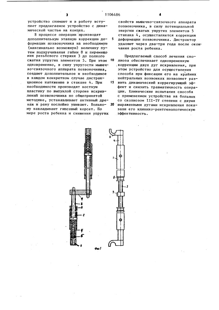 Способ лечения сколиоза и устройство для его осуществления (патент 1106486)