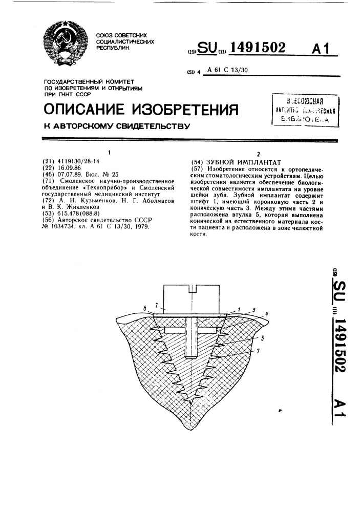 Зубной имплантат (патент 1491502)