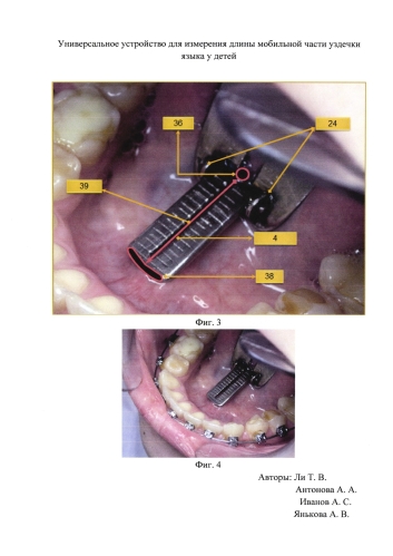 Универсальное устройство для измерения длины части уздечки языка у детей (патент 2584138)