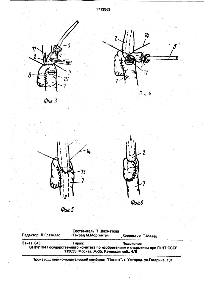 Способ формирования пищеводно-кишечного анастомоза (патент 1713563)