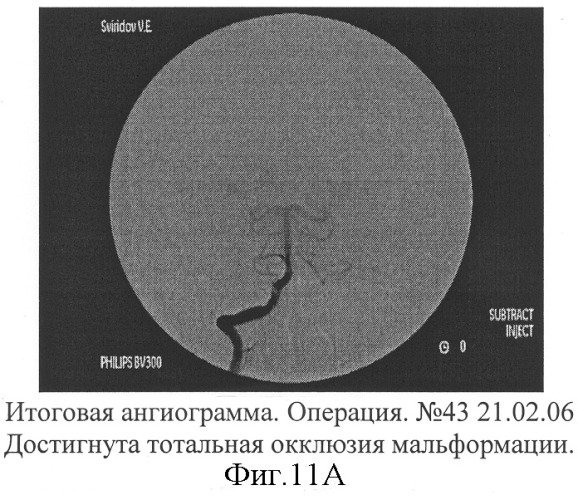 Способ эмболизации артериовенозных мальформаций головного мозга в условиях общей анестезии и управляемой гипотонии (патент 2315634)