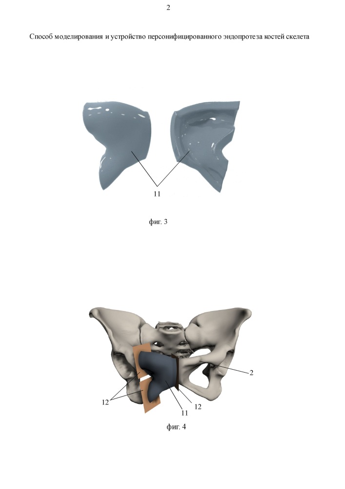 Способ моделирования и устройство персонифицированного эндопротеза костей скелета (патент 2651104)