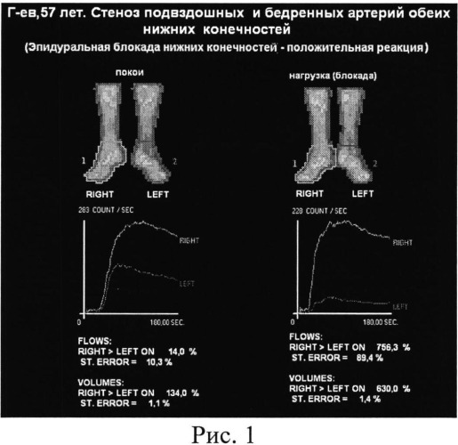 Способ оценки резервов дистального кровообращения конечностей (патент 2530764)