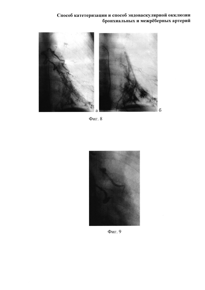 Способ катетеризации и способ эндоваскулярной окклюзии бронхиальных и межрёберных артерий (патент 2661097)