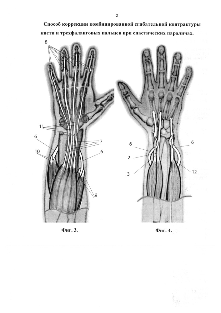 Способ коррекции комбинированной сгибательной контрактуры кисти и трехфаланговых пальцев при спастических параличах (патент 2648862)