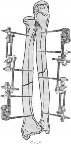 Способ чрескостного остеосинтеза диафизарных повреждений костей предплечья и аппарат для его осуществления (патент 2328242)