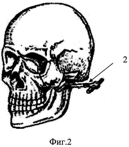Способ фиксации переломов скуловой кости металлическими спицами (патент 2572452)