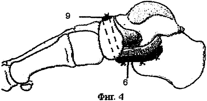 Способ хирургического лечения продольного плоскостопия у взрослых (патент 2344782)