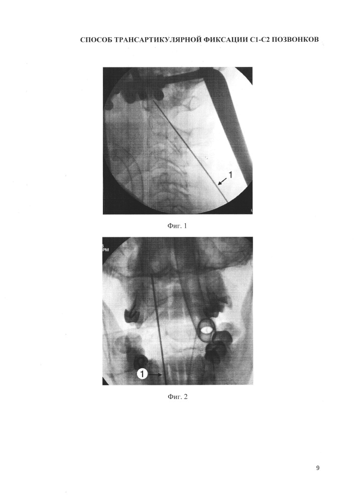 Способ выполнения трансартикулярной фиксации с1-с2 позвонков (патент 2662203)